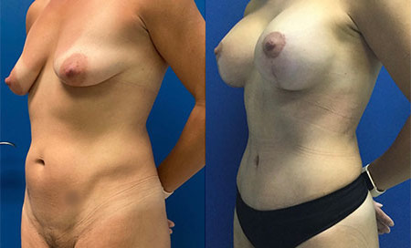 mommy makeover before and after photo by reichner plastic surgery in orange ca