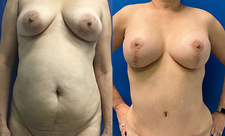 mommy makeover before and after photo by reichner plastic surgery in orange ca