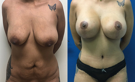mommy makeover before and after photo by reichner plastic surgery in orange ca