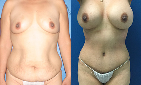 mommy makeover before and after photo by reichner plastic surgery in orange ca