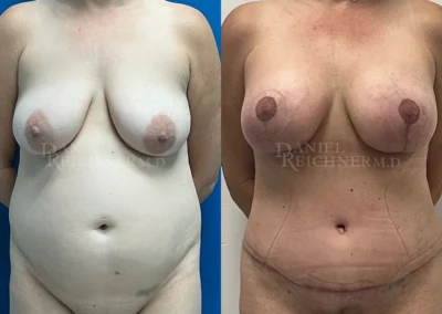mommy makeover before and after photo by reichner plastic surgery in orange ca