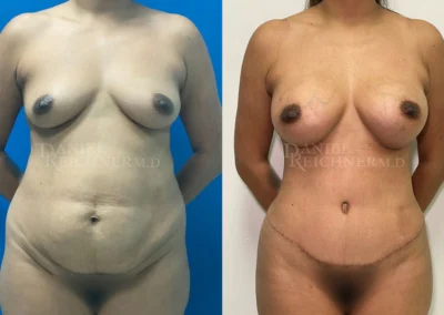 mommy makeover before and after photo by reichner plastic surgery in orange ca