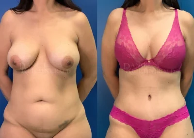 mommy makeover before and after photo by reichner plastic surgery in orange ca