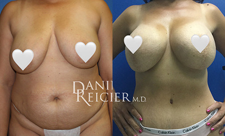 mommy makeover before and after photo by reichner plastic surgery in orange ca