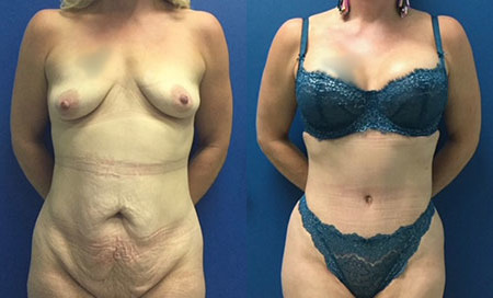 mommy makeover before and after photo by reichner plastic surgery in orange ca