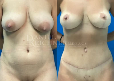 mommy makeover before and after photo by reichner plastic surgery in orange ca