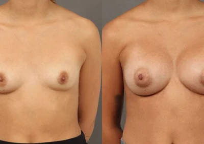 breast augmentation before and after photo by reichner plastic surgery in orange ca