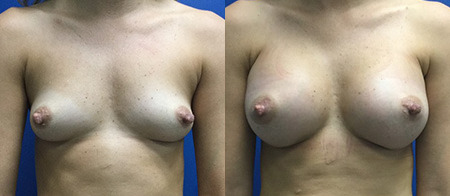 breast augmentation before and after photo by reichner plastic surgery in orange ca