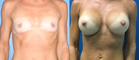 breast augmentation before and after photo by reichner plastic surgery in orange ca
