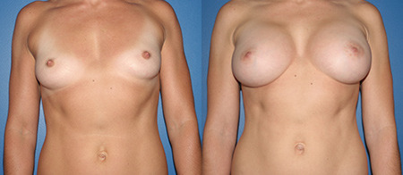 breast augmentation before and after photo by reichner plastic surgery in orange ca