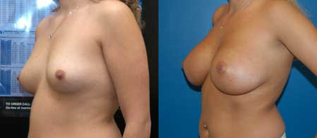 breast augmentation before and after photo by reichner plastic surgery in orange ca