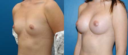 breast augmentation before and after photo by reichner plastic surgery in orange ca