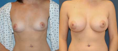 breast augmentation before and after photo by reichner plastic surgery in orange ca