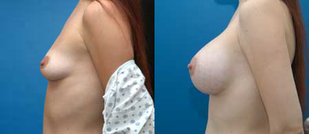 breast augmentation before and after photo by reichner plastic surgery in orange ca