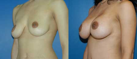 breast augmentation before and after photo by reichner plastic surgery in orange ca