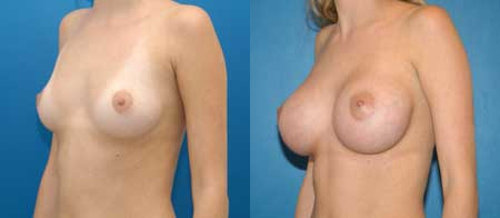 breast augmentation before and after photo by reichner plastic surgery in orange ca