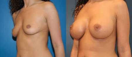 breast augmentation before and after photo by reichner plastic surgery in orange ca