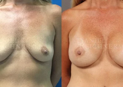 breast augmentation before and after photo by reichner plastic surgery in orange ca