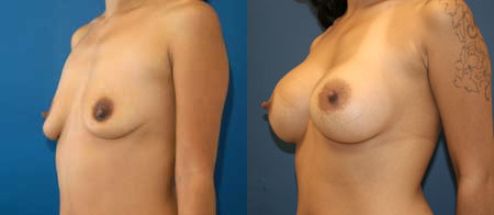 breast augmentation before and after photo by reichner plastic surgery in orange ca