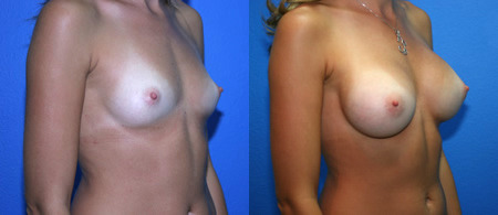 breast augmentation before and after photo by reichner plastic surgery in orange ca