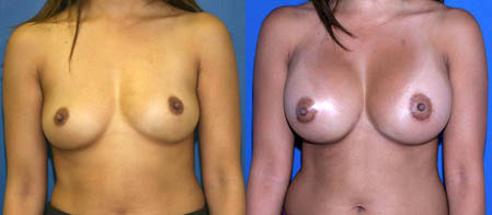 breast augmentation before and after photo by reichner plastic surgery in orange ca