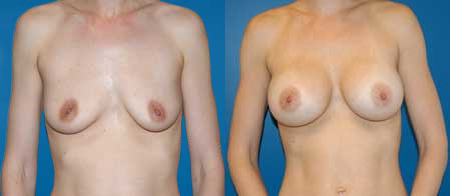 breast augmentation before and after photo by reichner plastic surgery in orange ca