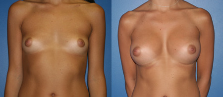 breast augmentation before and after photo by reichner plastic surgery in orange ca