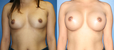 breast augmentation before and after photo by reichner plastic surgery in orange ca