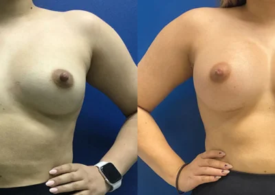 breast augmentation before and after photo by reichner plastic surgery in orange ca