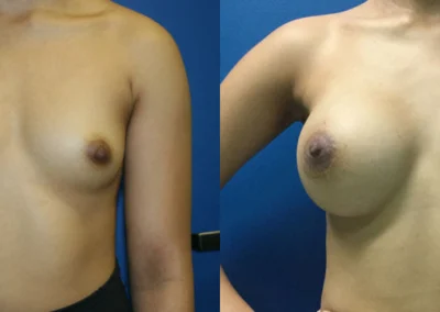 breast augmentation before and after photo by reichner plastic surgery in orange ca