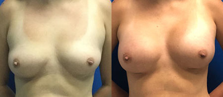 breast augmentation before and after photo by reichner plastic surgery in orange ca