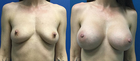 breast augmentation before and after photo by reichner plastic surgery in orange ca