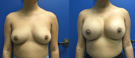 breast augmentation before and after photo by reichner plastic surgery in orange ca