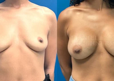 breast augmentation before and after photo by reichner plastic surgery in orange ca