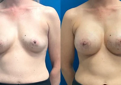 breast augmentation before and after photo by reichner plastic surgery in orange ca