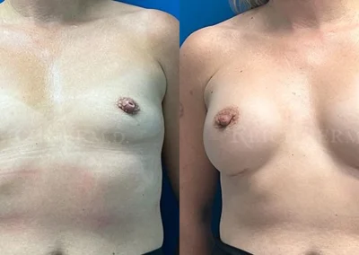 breast augmentation before and after photo by reichner plastic surgery in orange ca