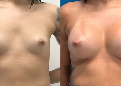 breast augmentation before and after photo by reichner plastic surgery in orange ca