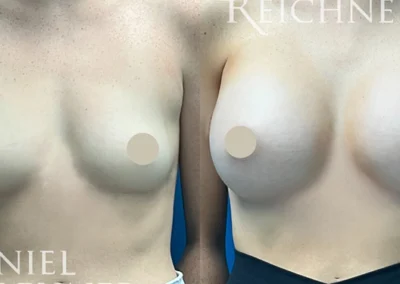 breast augmentation before and after photo by reichner plastic surgery in orange ca