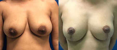 breast implant exchange before and after photo by reichner plastic surgery in orange ca
