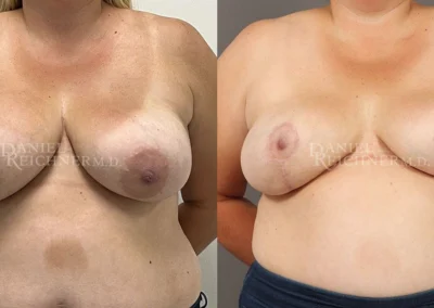 breast implant removal explant before and after photo by reichner plastic surgery in orange ca