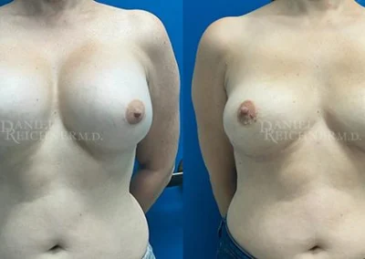 breast implant removal explant before and after photo by reichner plastic surgery in orange ca