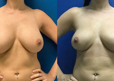 breast implant removal explant before and after photo by reichner plastic surgery in orange ca