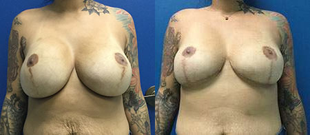 breast implant removal explant before and after photo by reichner plastic surgery in orange ca