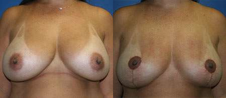 breast implant removal explant before and after photo by reichner plastic surgery in orange ca