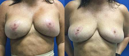 breast implant removal explant before and after photo by reichner plastic surgery in orange ca