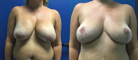 breast implant removal explant before and after photo by reichner plastic surgery in orange ca