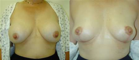 breast implant removal explant before and after photo by reichner plastic surgery in orange ca