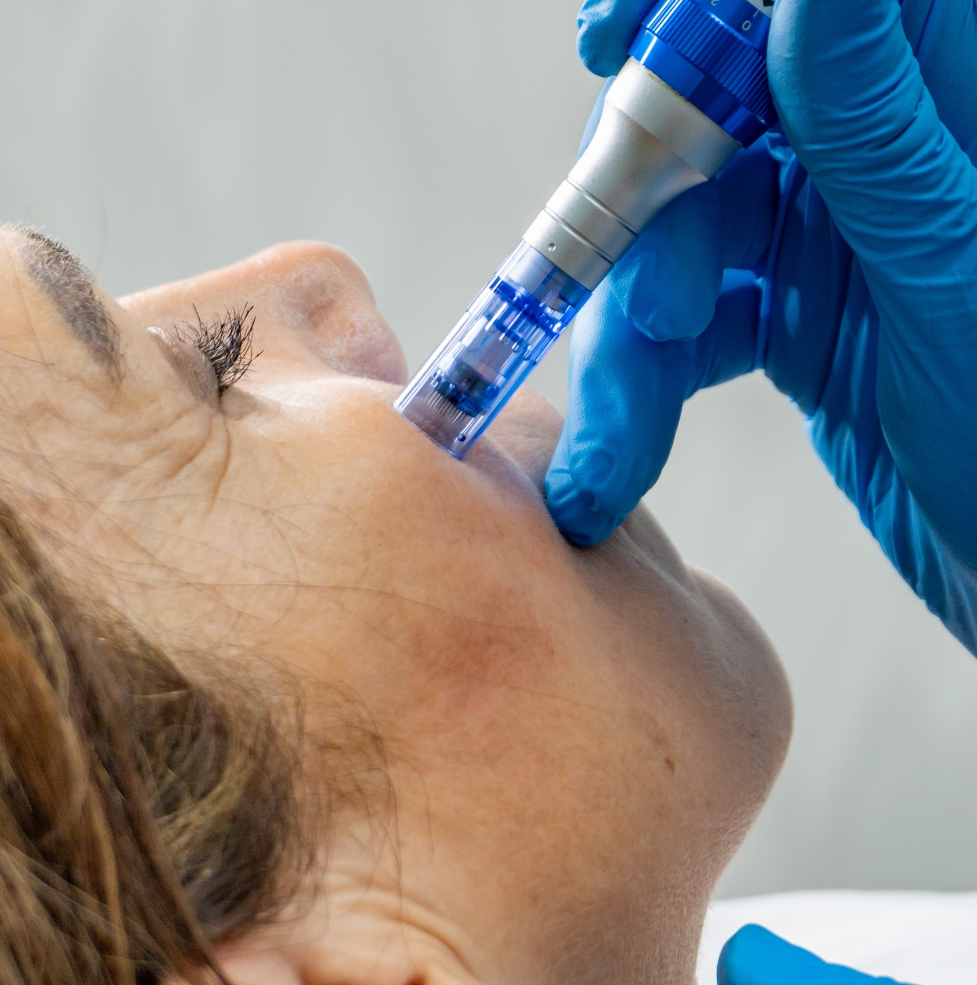 woman receiving rf microneedling treatment